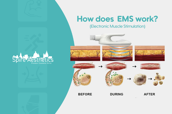 EMS treatment for post pregnancy weight loss treatment Bradford