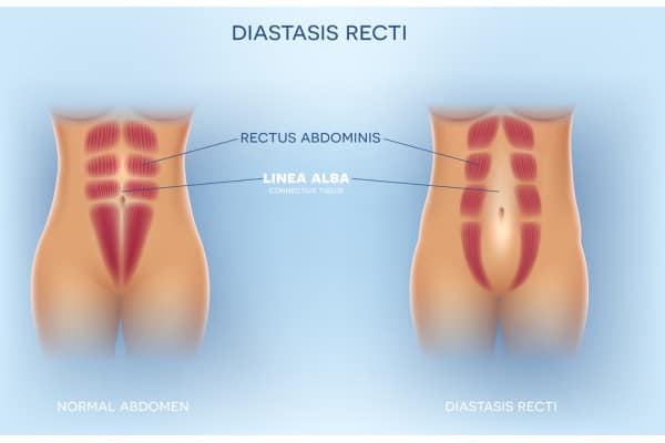 What Non-Surgical Options Are Available for Diastasis Recti Bradford?