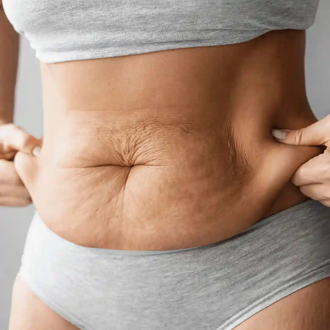 Is It Normal to Have Loose Skin After Pregnancy Bradford?