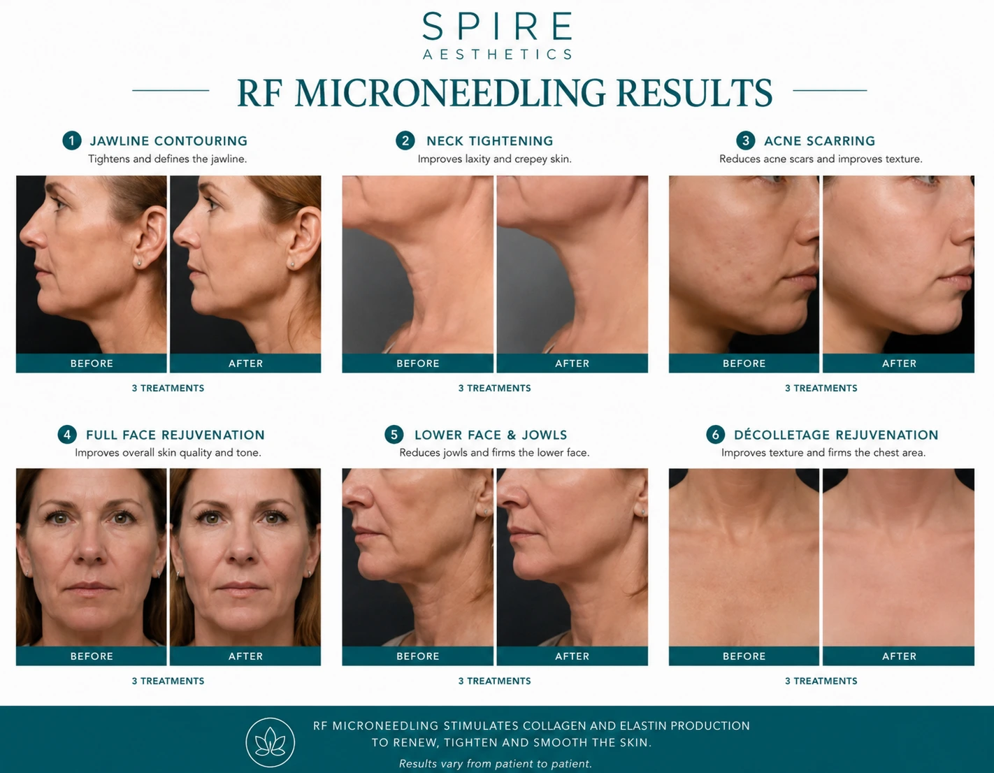 RF Microneedling Skin tightening Bradford results