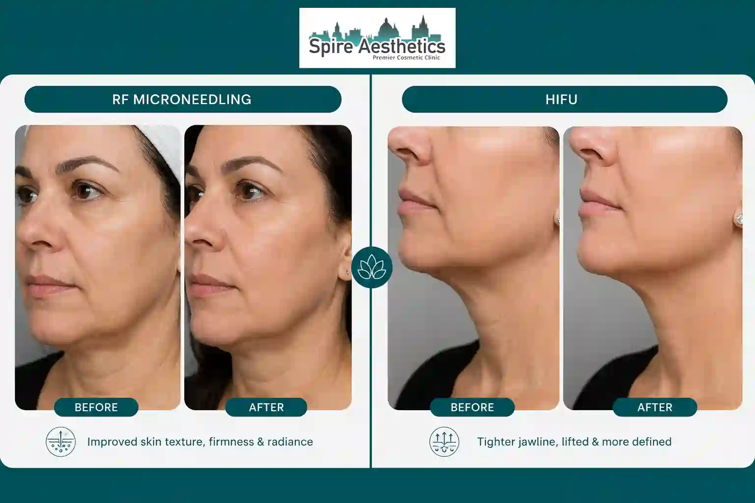 Can RF Microneedling and HIFU Be Combined Bradford?