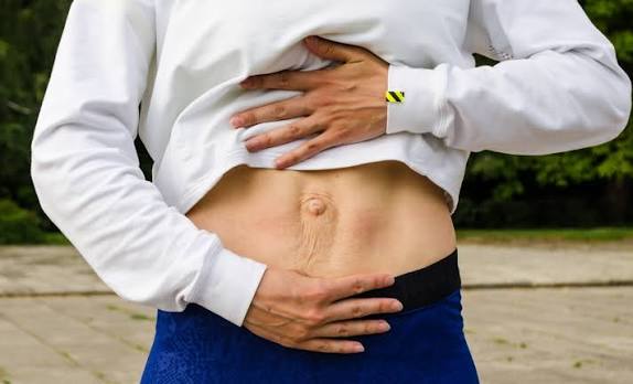 When Could Diastasis Recti Be the Missing Piece of the Puzzle Bradford?