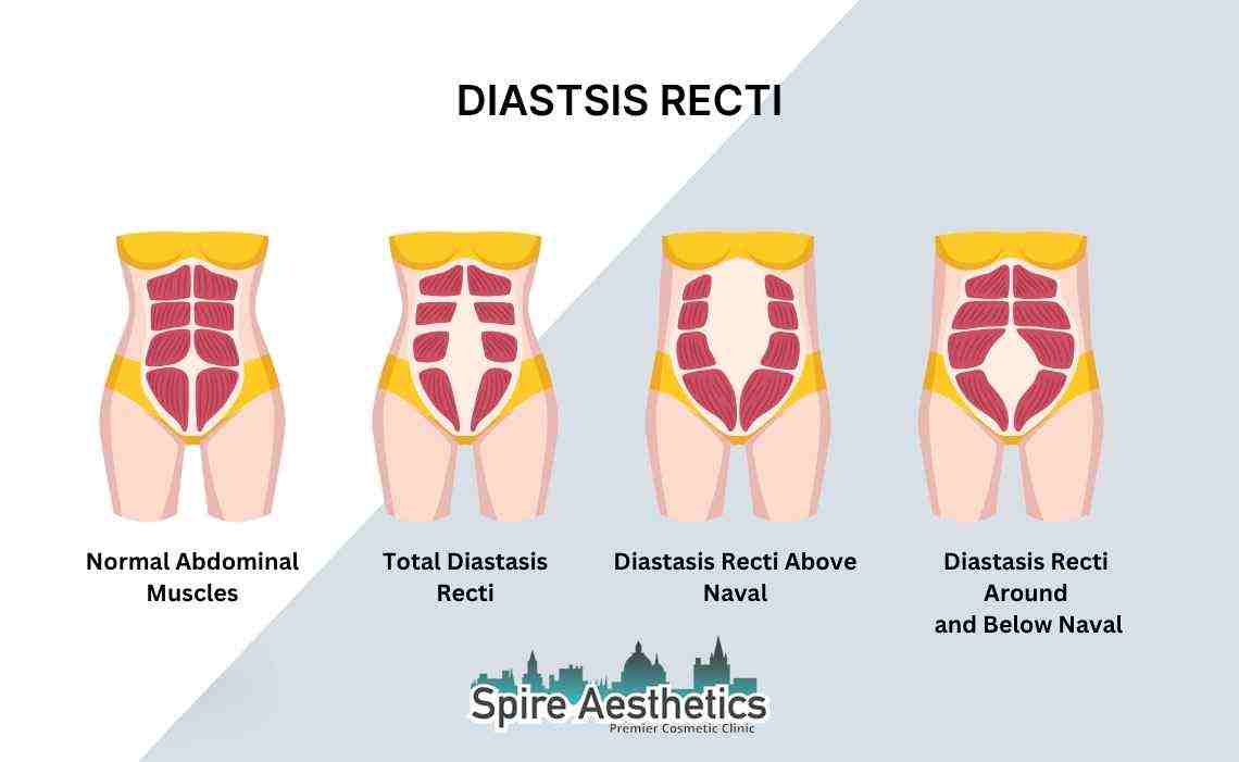 Is Non-Surgical Diastasis Recti Treatment Right for You? Common Concerns Answered Bradford